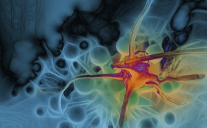 A cancer cell illustration